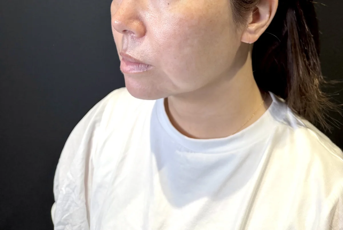 術前