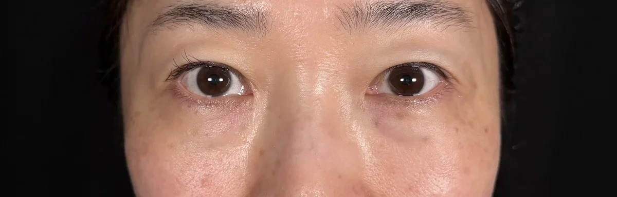 術前